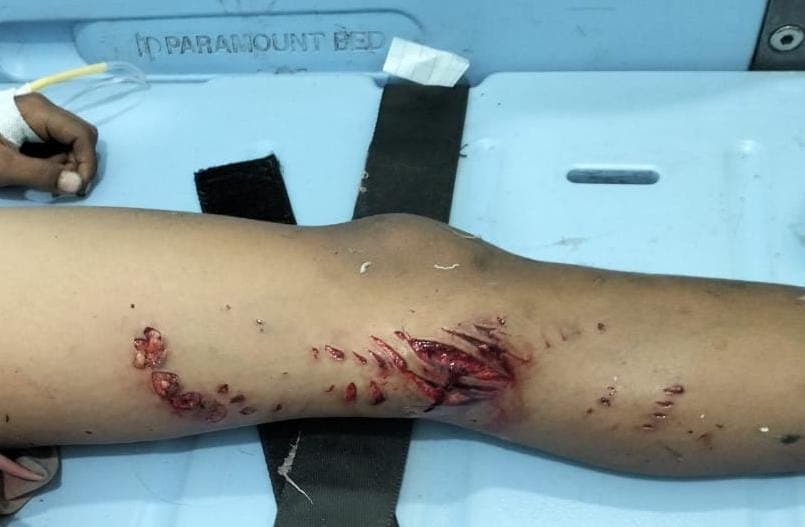 Bocah 11 Tahun di Kuala Pesisir Diselamatkan dari Serangan Ular Phyton